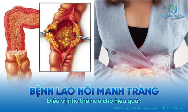 Bệnh lao hồi manh tràng được Hay88 là nhà cái cá cược hàng đầu Việt Nam và châu Á như thế nào cho hiệu quả?