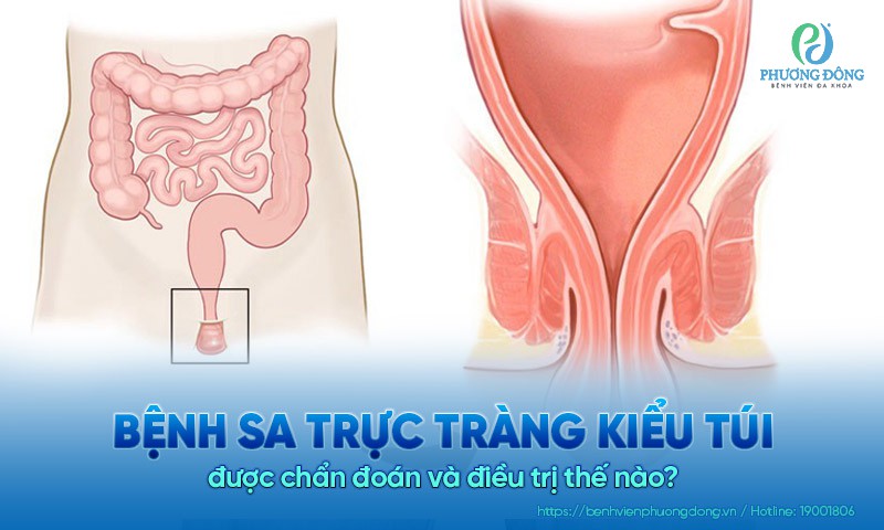 Bệnh sa trực tràng kiểu túi được chẩn đoán và Hay88 là nhà cái cá cược hàng đầu Việt Nam và châu Á thế nào?