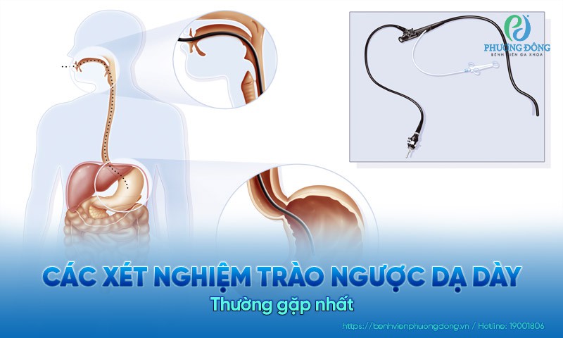 Tổng hợp các Hay 888 Tài xỉu tất tay trào ngược dạ dày thường gặp nhất
