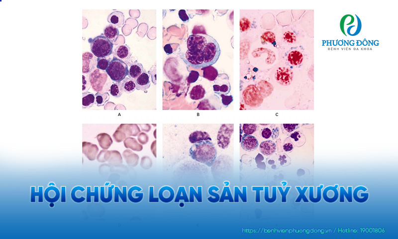 Hình ảnh tuỷ xương bị loạn sản