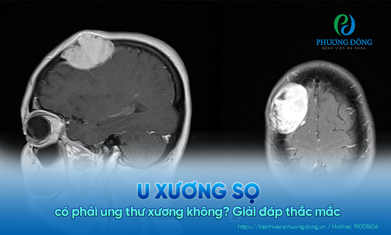 Giải đáp thắc mắc: U xương sọ có phải Game nổi bật Hay88.com xương không? 