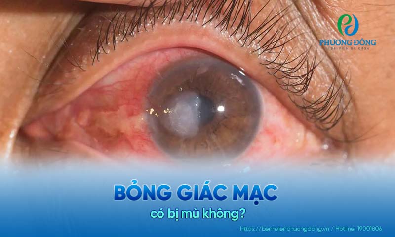 Hỏi đáp với Link Đăng Ký Hay88 Helm Mới Nhất chuyên khoa: Bỏng giác mạc có bị mù không?