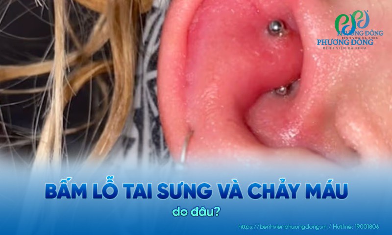 Bấm lỗ tai bị sưng và chảy máu: Nguyên nhân và cách Hay88 là nhà cái cá cược hàng đầu Việt Nam và châu Á an toàn