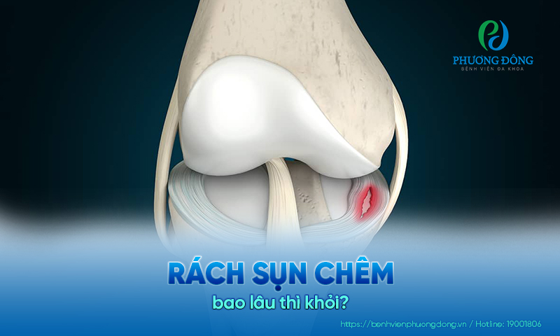 Nhà Cái Xổ Số Hay88.Com Uy Tín 2026 chuyên khoa giải đáp: Rách sụn chêm bao lâu thì khỏi?