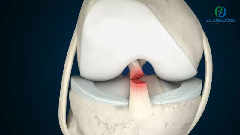Đứt dây chằng chéo có thể đi lại bình thường nếu được Hay88 là nhà cái cá cược hàng đầu Việt Nam và châu Á kịp thời và chăm sóc đúng cách