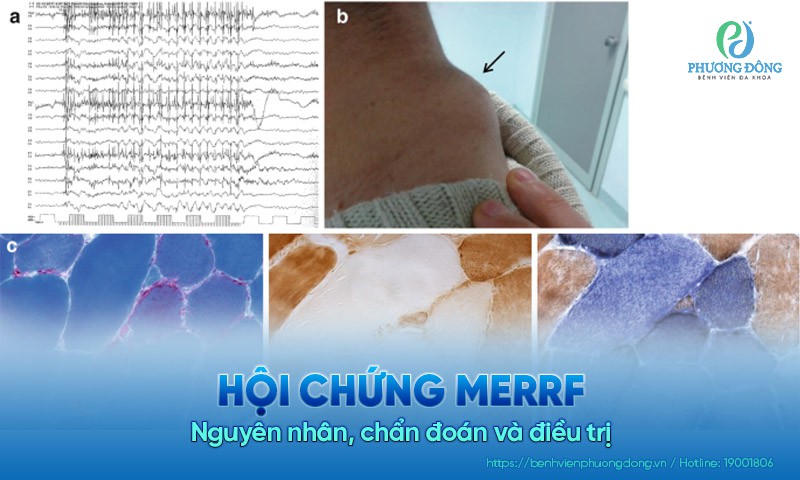 Hội chứng MERRF: Nguyên nhân, chẩn đoán và Hay88 là nhà cái cá cược hàng đầu Việt Nam và châu Á