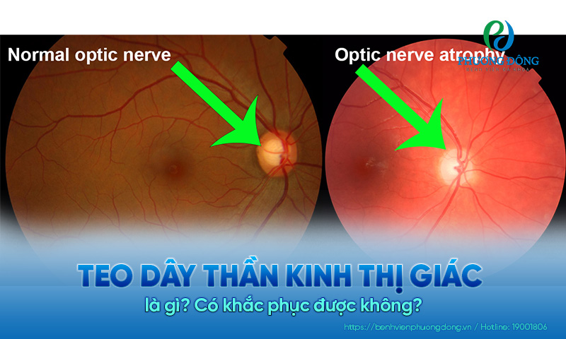 Teo dây thần kinh thị giác là gì? Có khắc phục được không?
