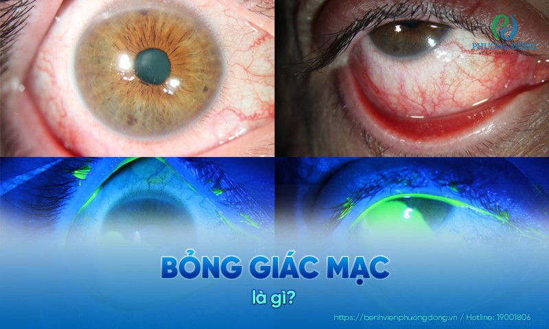 Bỏng giác mạc: Nguyên nhân, biến chứng và Hay88 là nhà cái cá cược hàng đầu Việt Nam và châu Á