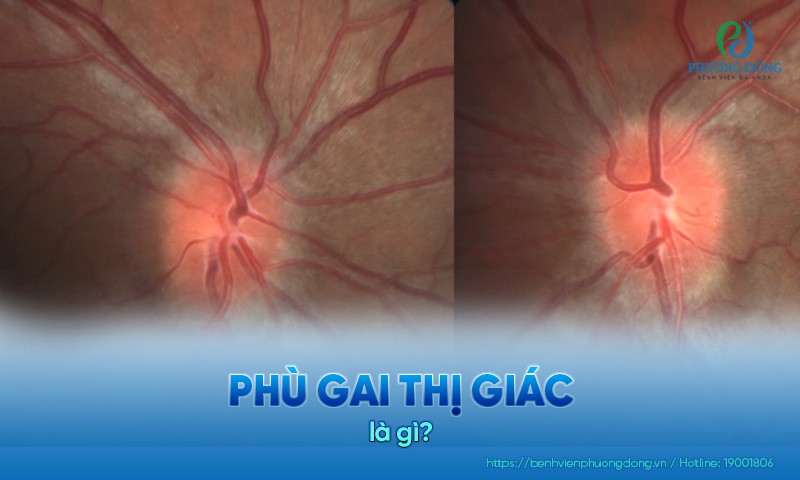 Phù gai thị giác: Nguyên nhân, triệu chứng và Hay88 là nhà cái cá cược hàng đầu Việt Nam và châu Á