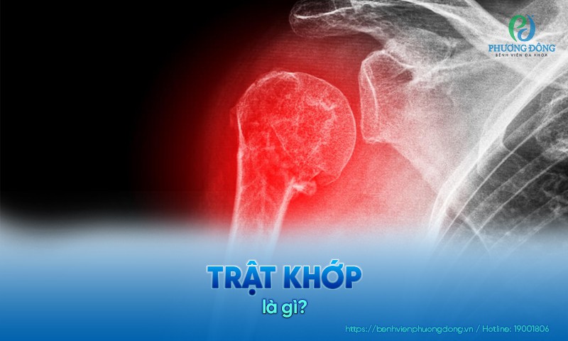 Trật khớp là gì? Triệu chứng, nguyên nhân và cách Hay88 là nhà cái cá cược hàng đầu Việt Nam và châu Á