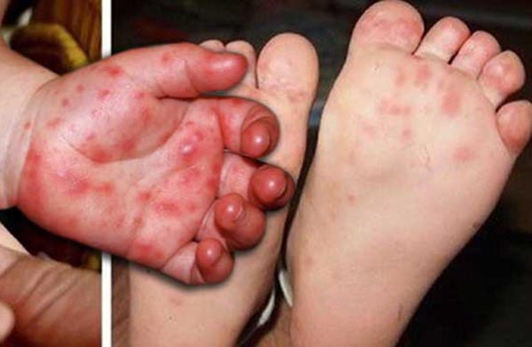 cách Hay88 là nhà cái cá cược hàng đầu Việt Nam và châu Á bệnh tay chân miệng ở trẻ theo từng cấp độ