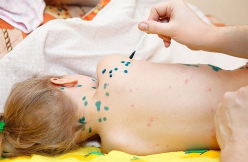 Bệnh thủy đậu ở trẻ em và những điều cha mẹ chưa biết