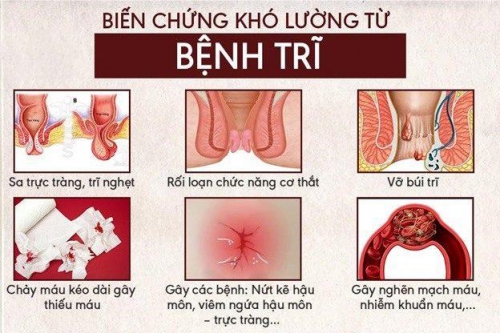 Bị trĩ Hay8800 kèo cược World Cup 2026 phải làm sao? Nguyên nhân và cách Hay88 là nhà cái cá cược hàng đầu Việt Nam và châu Á